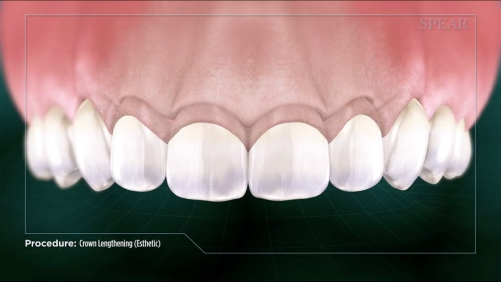 Clinical Crown Lengthening | Chapel Hill Periodontics & Implants