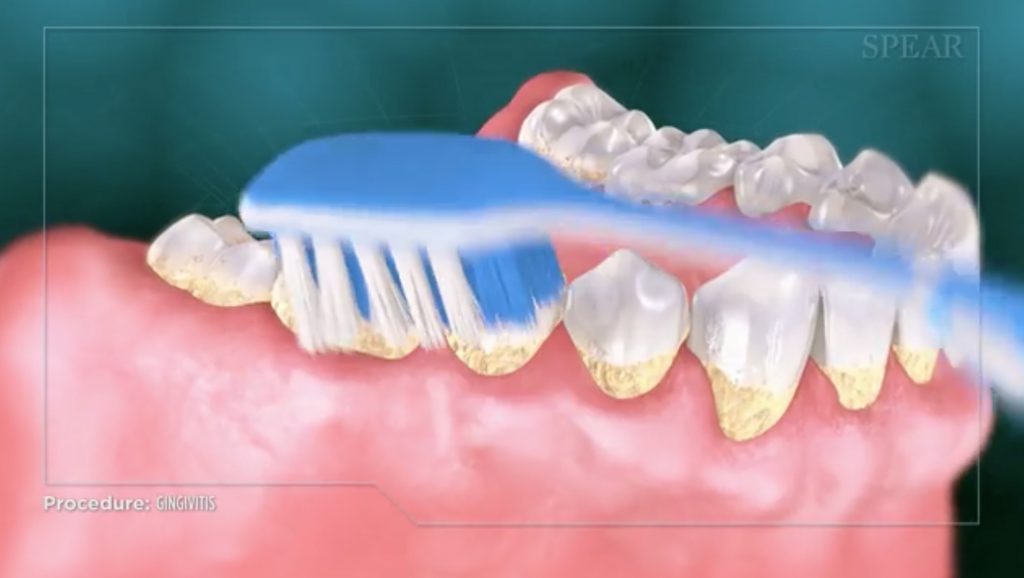 Gingivectomy | Chapel Hill Periodontics & Implants