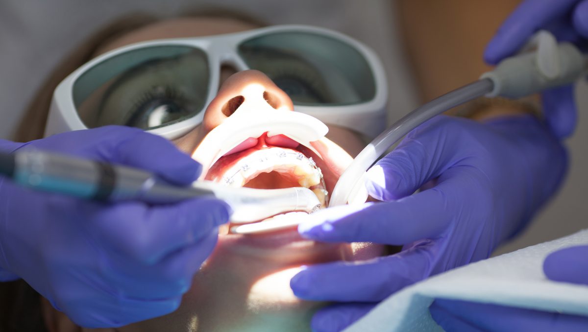 Laser Assisted New Attachment Procedure (LANAP) Chapel Hill