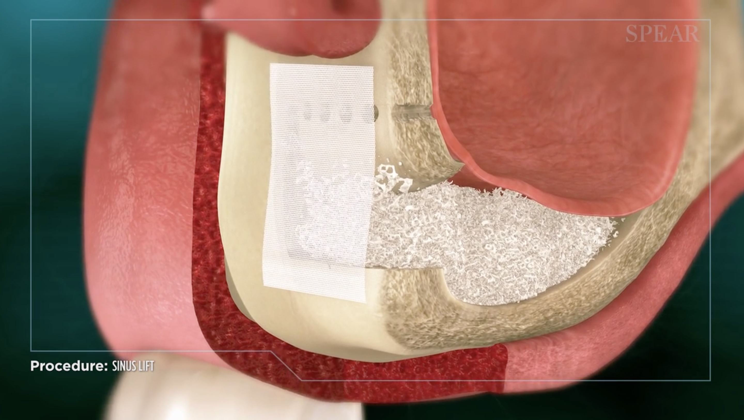 Sinus Augmentation Procedure Code